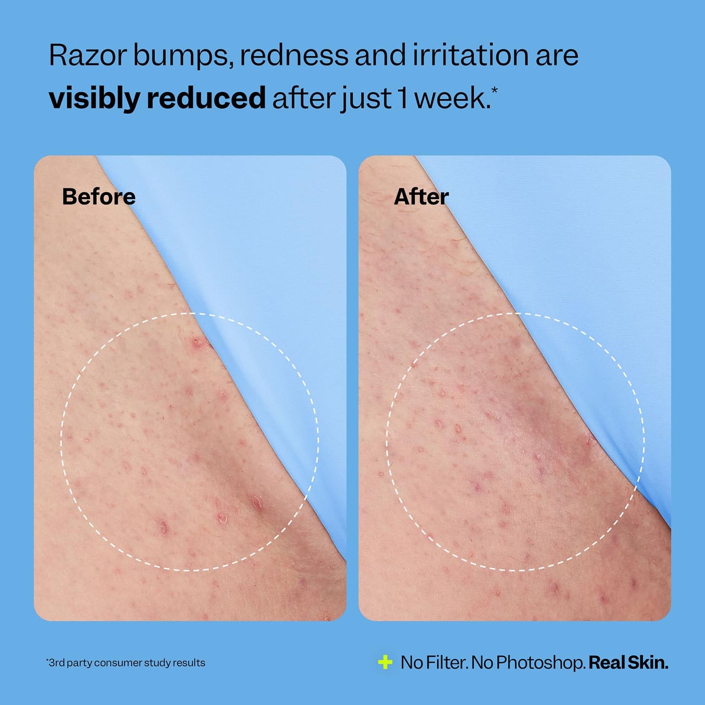 Vovexa™ Smoothing Solution for Ingrown Hair